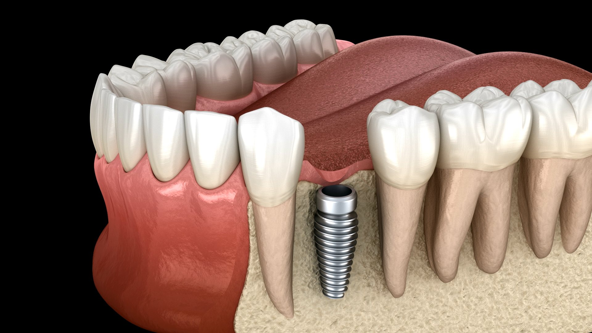 Wizualizacja implantu stomatologicznego w łuku zębowym